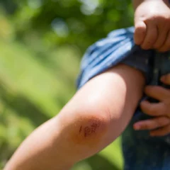 1. Superficial INJURIES - HOW TO MANAGE THEM WITH GREEN FOODS 1. Superficial INJURIES - HOW TO MANAGE THEM WITH GREEN FOODS